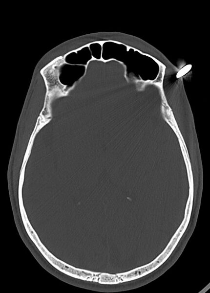 File:Arrow injury to the head (Radiopaedia 75266-86388 Axial bone window 74).jpg