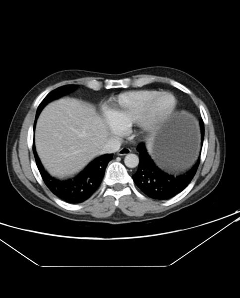 File:Arterial occlusive mesenteric ischemia (Radiopaedia 84641-100054 A 8).jpg