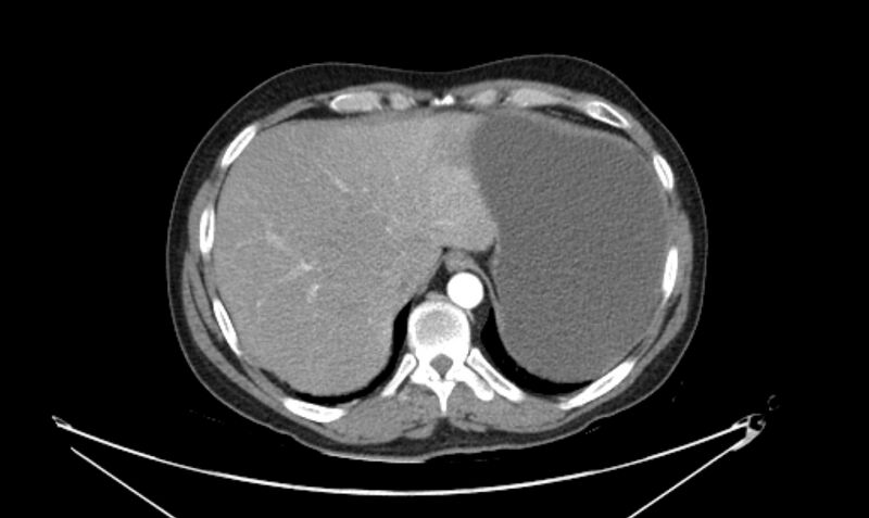 File:Arterial occlusive mesenteric ischemia (Radiopaedia 84641-100060 A 26).jpg