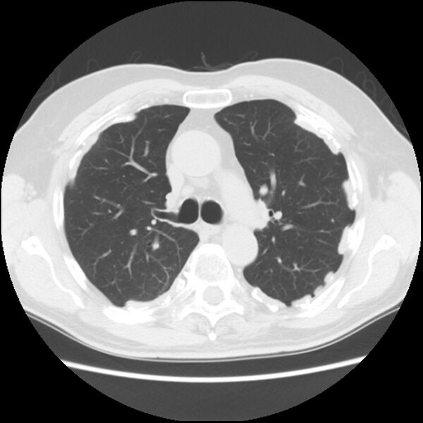 File:Asbestos-related pleural plaques (Radiopaedia 39069-41255 Axial lung window 27).jpg