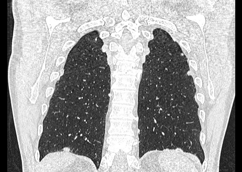 File:Asbestos pleural placques (Radiopaedia 57905-64872 Coronal lung window 235).jpg