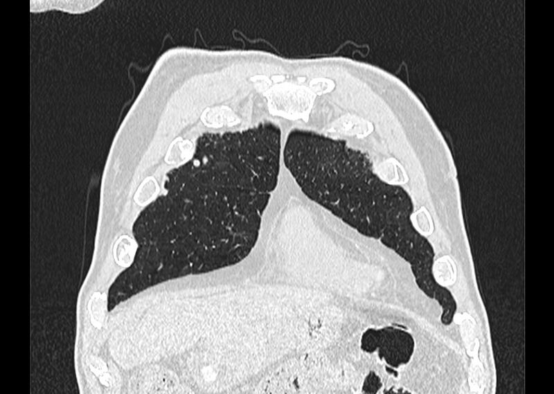 File:Asbestos pleural placques (Radiopaedia 57905-64872 Coronal lung window 32).jpg