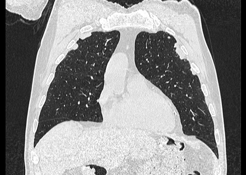 File:Asbestos pleural placques (Radiopaedia 57905-64872 Coronal lung window 74).jpg
