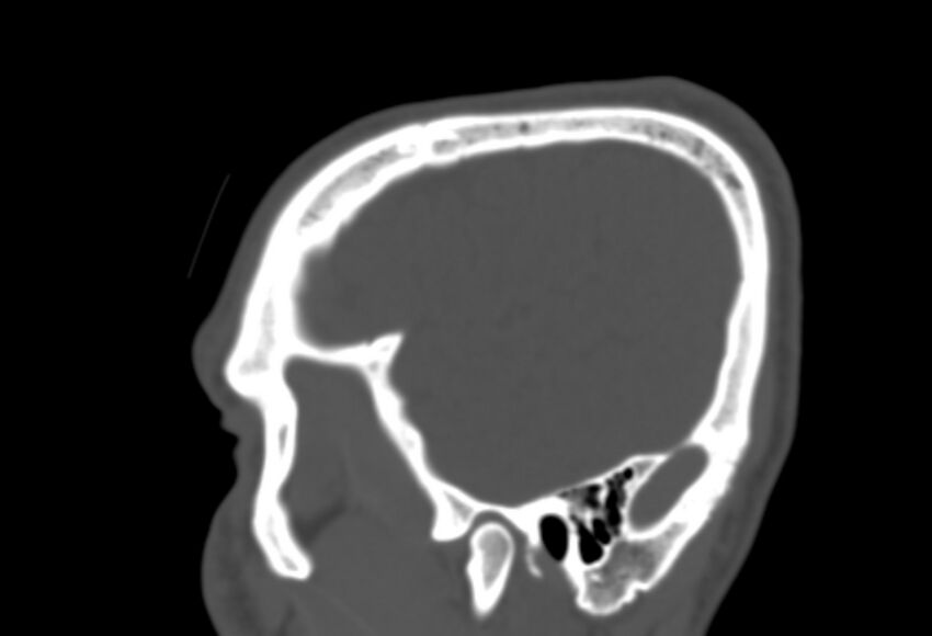 Asymptomatic occipital spur (Radiopaedia 87753-104201 Sagittal bone window 36).jpg