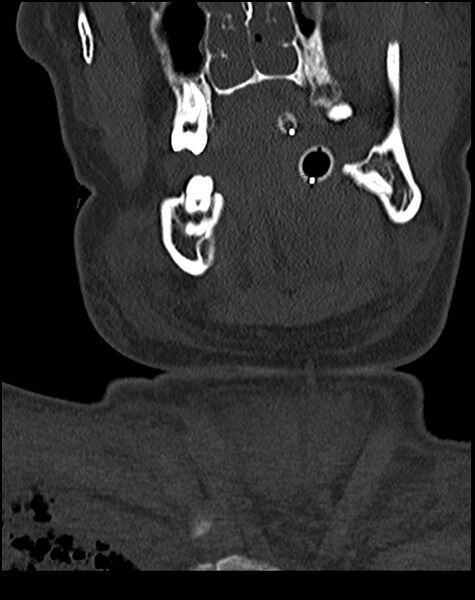 File:Atlanto-occipital dissociation - Traynelis type 1 (Radiopaedia 87570-103948 Coronal bone window 2).jpg