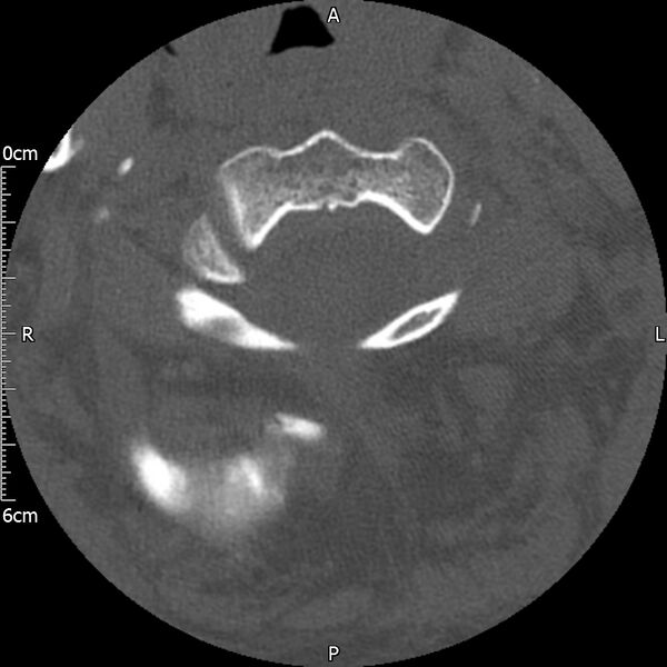 File:Atlas fracture with Currarino type A congenital defect (Radiopaedia 71747-82144 Axial bone window 48).jpg