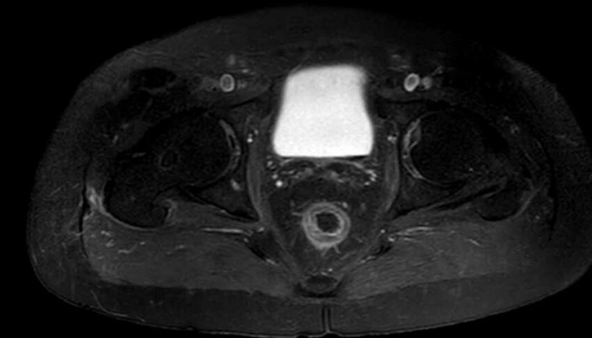 Atypical lipomatous tumor - thigh (Radiopaedia 68975-78734 Axial T1 C+ fat sat 92).jpg