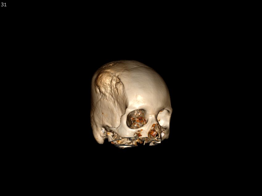 Atypical meningioma - intraosseous (Radiopaedia 64915-73867 3D volume render 31).jpg