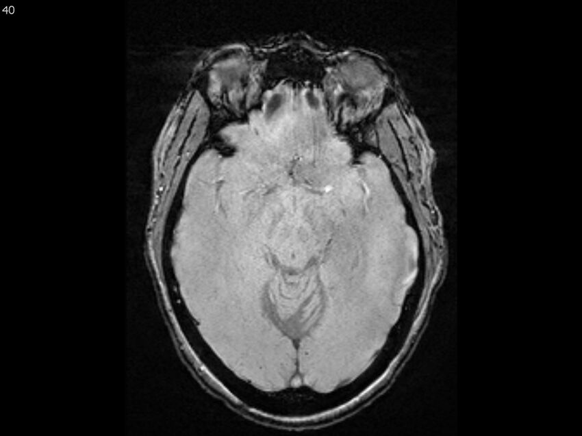 Atypical meningioma - intraosseous (Radiopaedia 64915-74572 Axial SWI 40).jpg