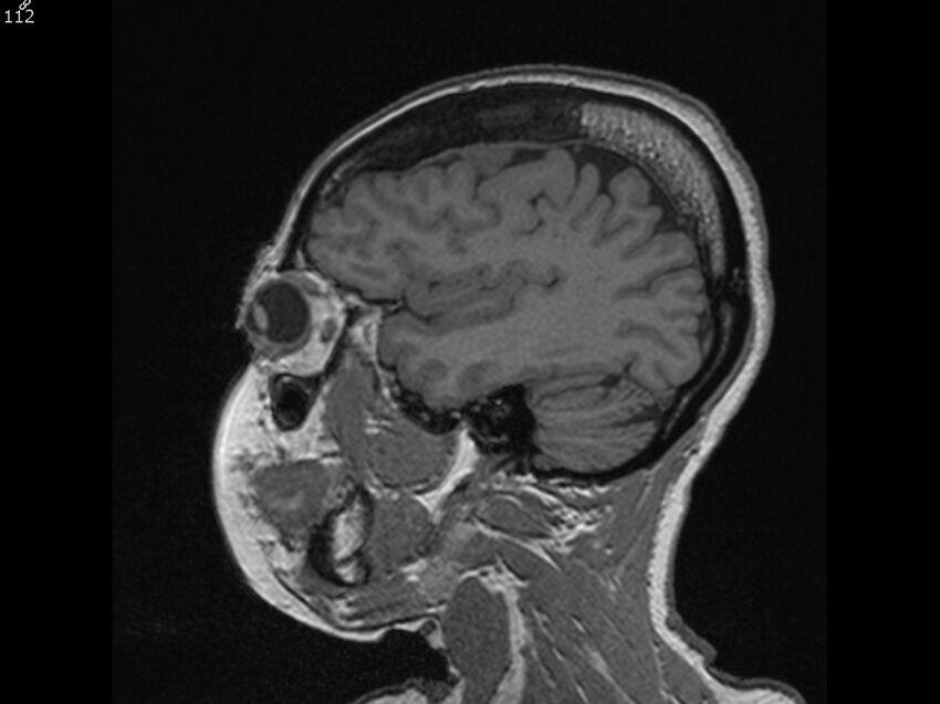 Atypical meningioma - intraosseous (Radiopaedia 64915-74572 Sagittal T1 112).jpg