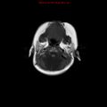 Atypical teratoid rhabdoid tumor (Radiopaedia 10712-11183 Axial T1 17).jpg