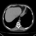 Autosomal dominant polycystic kidney disease (Radiopaedia 36539-38101 Axial non-contrast 10).jpg