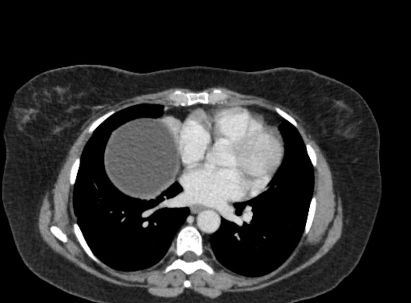 File:Autosomal dominant polycystic kidney disease (Radiopaedia 57124-64017 A 6).jpg