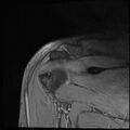 Avulsion fracture - greater tuberosity of humerus (Radiopaedia 71216-81515 Coronal T2 7).jpg