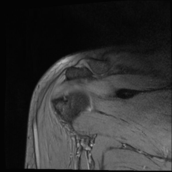 File:Avulsion fracture - greater tuberosity of humerus (Radiopaedia 71216-81515 Coronal T2 7).jpg