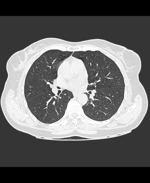 File:Azygos fissure and azygos lobe (Radiopaedia 41841-44832 Axial lung window 14).jpg