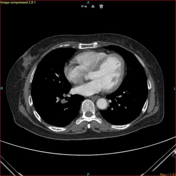 File:Azygos vein aneurysm (Radiopaedia 77824-90130 B 36).jpg