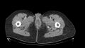 Bartholin gland abscess (Radiopaedia 11231-11596 B 1).jpg