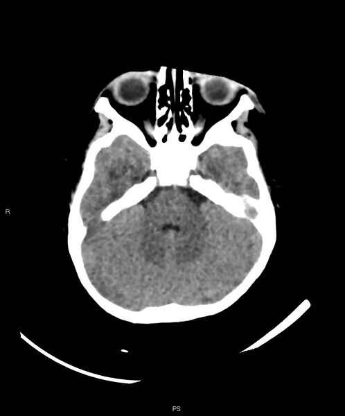 File:Basal ganglia and parenchymal ischemia (Radiopaedia 45818-50083 Axial non-contrast 33).jpg