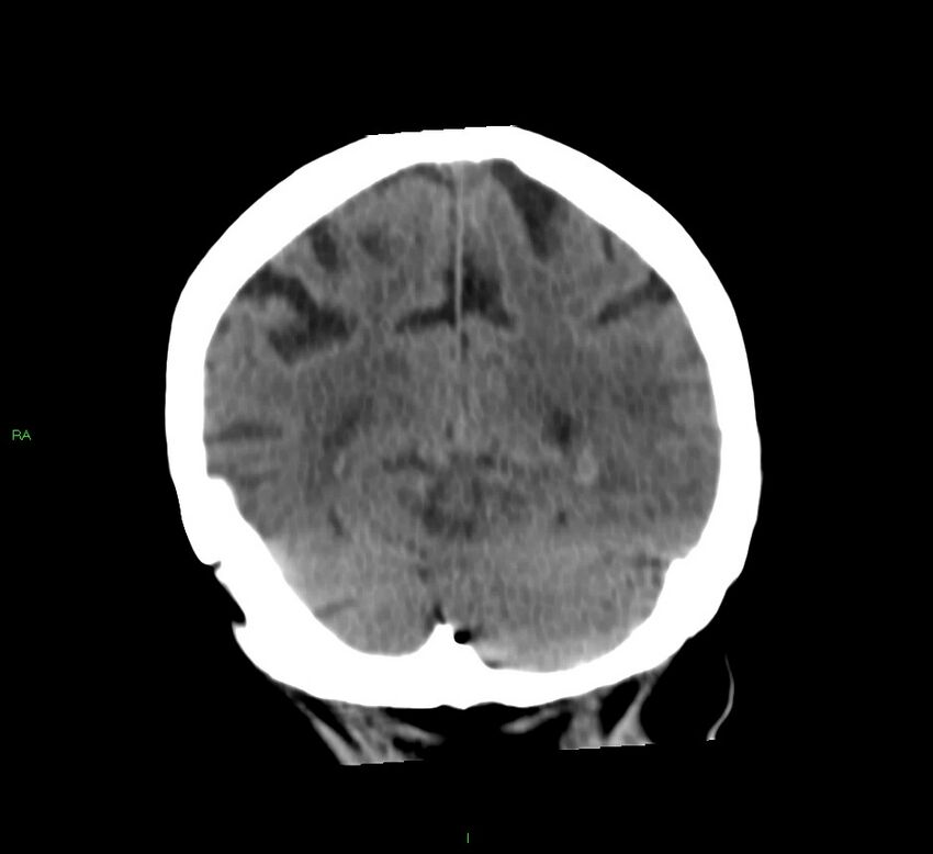 Basal ganglia hemorrhage (Radiopaedia 58790-66024 Coronal non-contrast 16).jpg