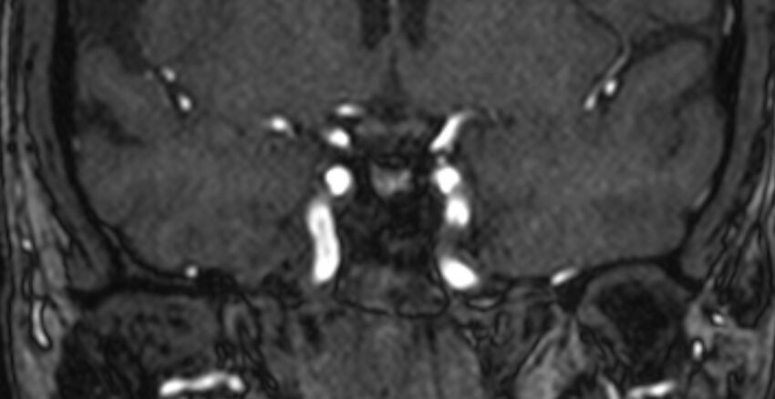 Basilar artery fenestration (Radiopaedia 74537-85455 Coronal MRA TOF 18).jpg