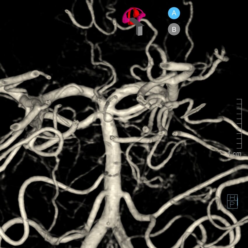 Basilar artery perforator aneurysm (Radiopaedia 82455-97734 3D view left VA 158).jpg