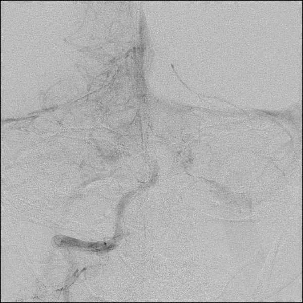 File:Basilar artery thrombosis treated with intra-arterial urokinase (Radiopaedia 34571-35949 B 22).png