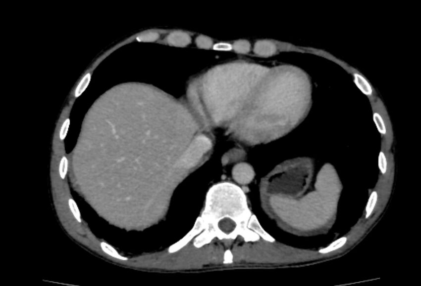 Behçet's disease- abdominal vasculitis (Radiopaedia 55955-62570 A 2).jpg