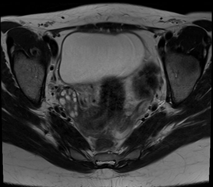 File:Bicornuate uterus (Radiopaedia 71214-81511 Axial T2 17).jpg