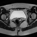 Bicornuate uterus (Radiopaedia 72135-82643 Axial T2 15).jpg