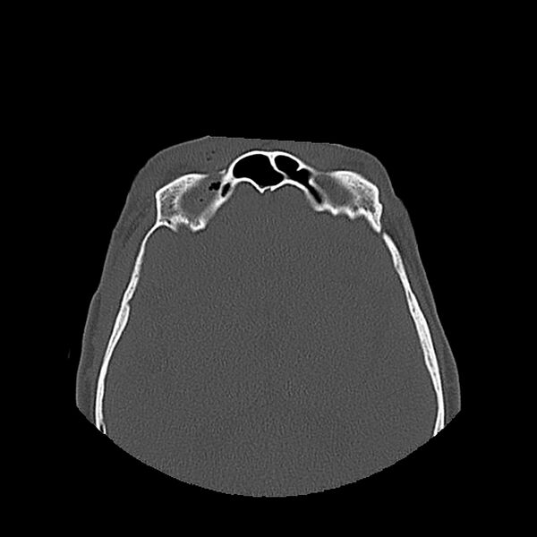 File:Bilateral Le Fort fractures (Radiopaedia 32192-33135 Axial bone window 76).jpg