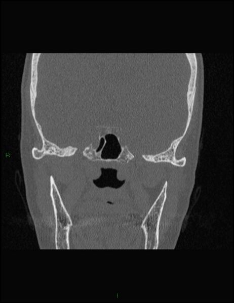 File:Bilateral frontal mucoceles (Radiopaedia 82352-96454 Coronal 247).jpg