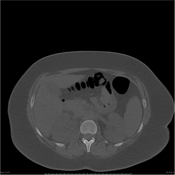 File:Bilateral lumbar ribs (Radiopaedia 25862-26010 bone window 11).jpg