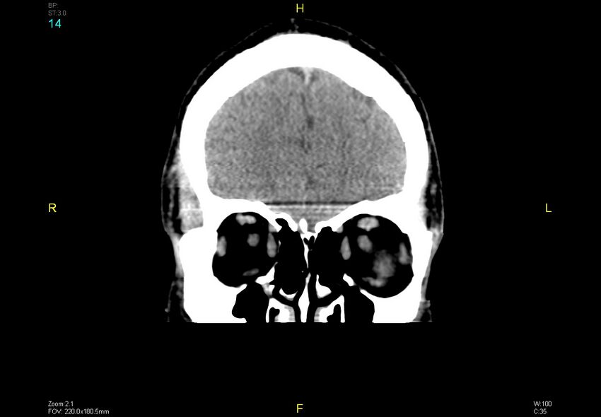 Bilateral medial medullary infarction (Radiopaedia 42220-45295 Coronal non-contrast 14).jpg