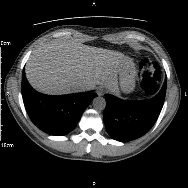 File:Bilateral medullary nephrocalcinosis with ureteric calculi (Radiopaedia 71269-81569 Axial non-contrast 3).jpg