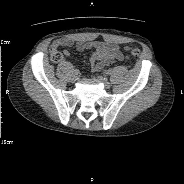 File:Bilateral medullary nephrocalcinosis with ureteric calculi (Radiopaedia 71269-81569 Axial non-contrast 98).jpg