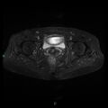 Bilateral ovarian fibroma (Radiopaedia 44568-48293 Axial STIR 21).jpg