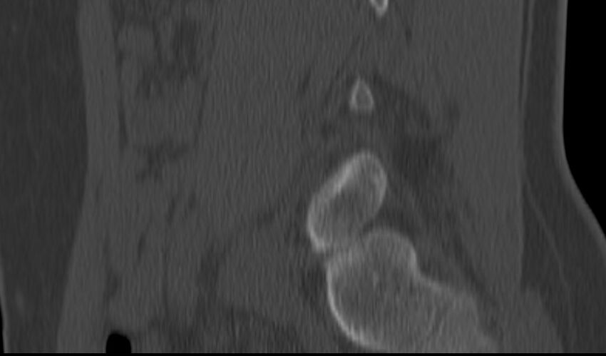 Bilateral pars defect (Radiopaedia 26691-26846 Sagittal bone window 47).jpg
