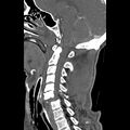 Bilateral perched facets with cord injury (Radiopaedia 45587-49713 B 25).jpg
