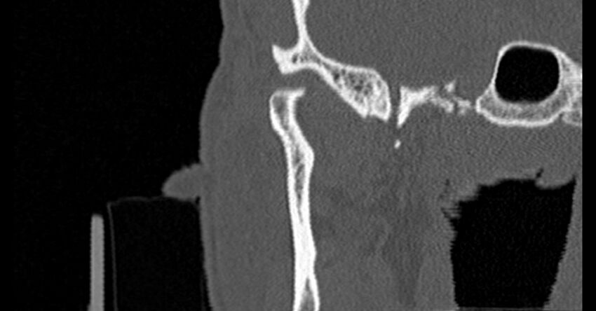 Bilateral temporal bone fractures (Radiopaedia 29482-29970 Coronal non-contrast 32).jpg