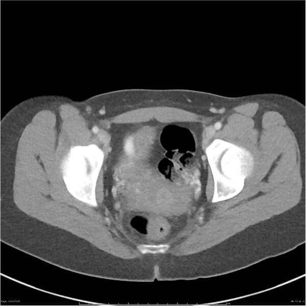 File:Bilateral ureteritis and cystitis (Radiopaedia 25340-25594 A 71).jpg