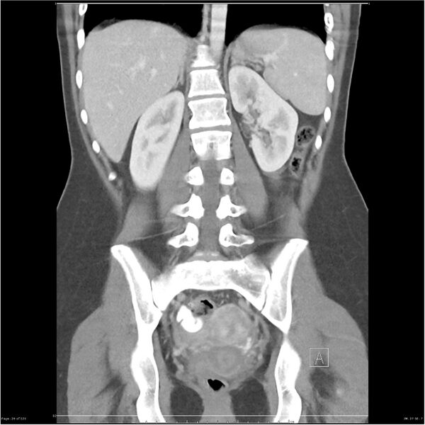 File:Bilateral ureteritis and cystitis (Radiopaedia 25340-25594 B 26).jpg