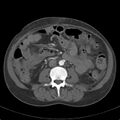Biliary necrosis - liver transplant (Radiopaedia 21876-21846 A 40).jpg