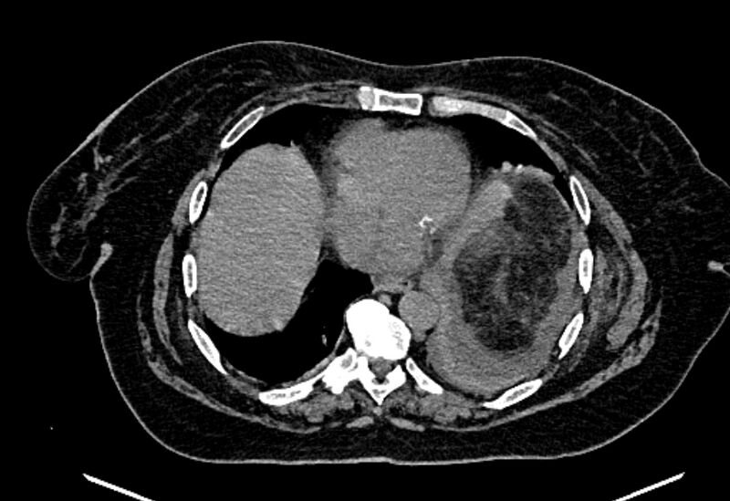 File:Biliary pancreatitis (Radiopaedia 72289-82823 Axial non-contrast 22).jpg