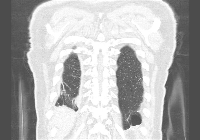 File:Birt-Hogg-Dubé syndrome (Radiopaedia 52578-58491 Coronal lung window 58).jpg