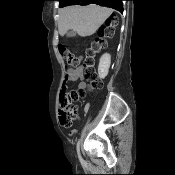 File:Bladder tumor detected on trauma CT (Radiopaedia 51809-57609 E 56).jpg
