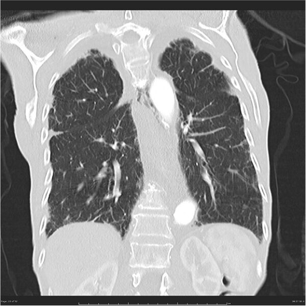 File:Boerhaave syndrome (Radiopaedia 26240-26362 Coronal lung window 23).jpg