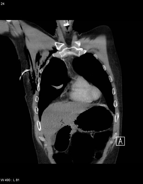 File:Boerhaave syndrome with tension pneumothorax (Radiopaedia 56794-63605 B 7).jpg