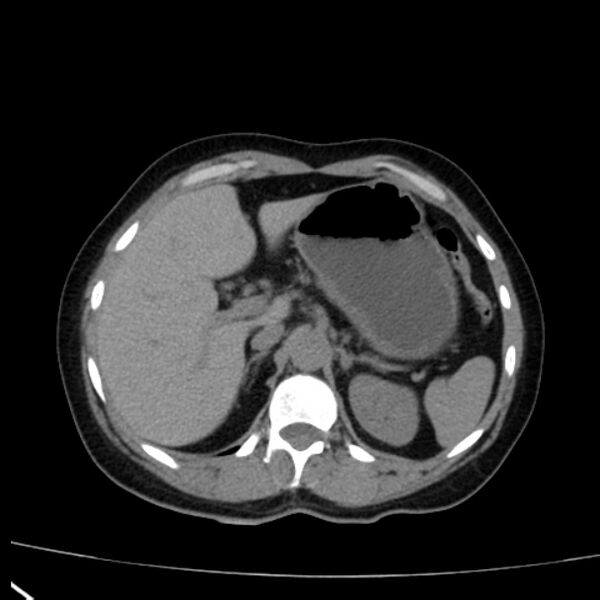 File:Bosniak renal cyst - type I (Radiopaedia 27479-27675 Axial non-contrast 22).jpg