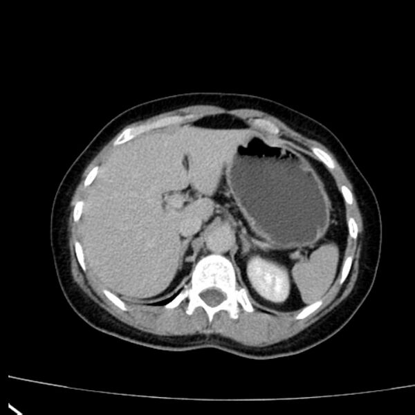 File:Bosniak renal cyst - type I (Radiopaedia 27479-27675 D 4).jpg